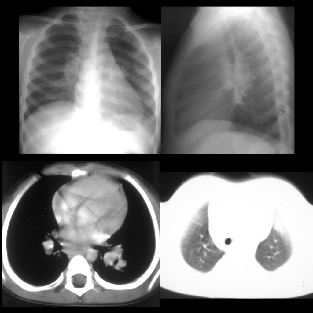 CXR and CT of tuberculosis
