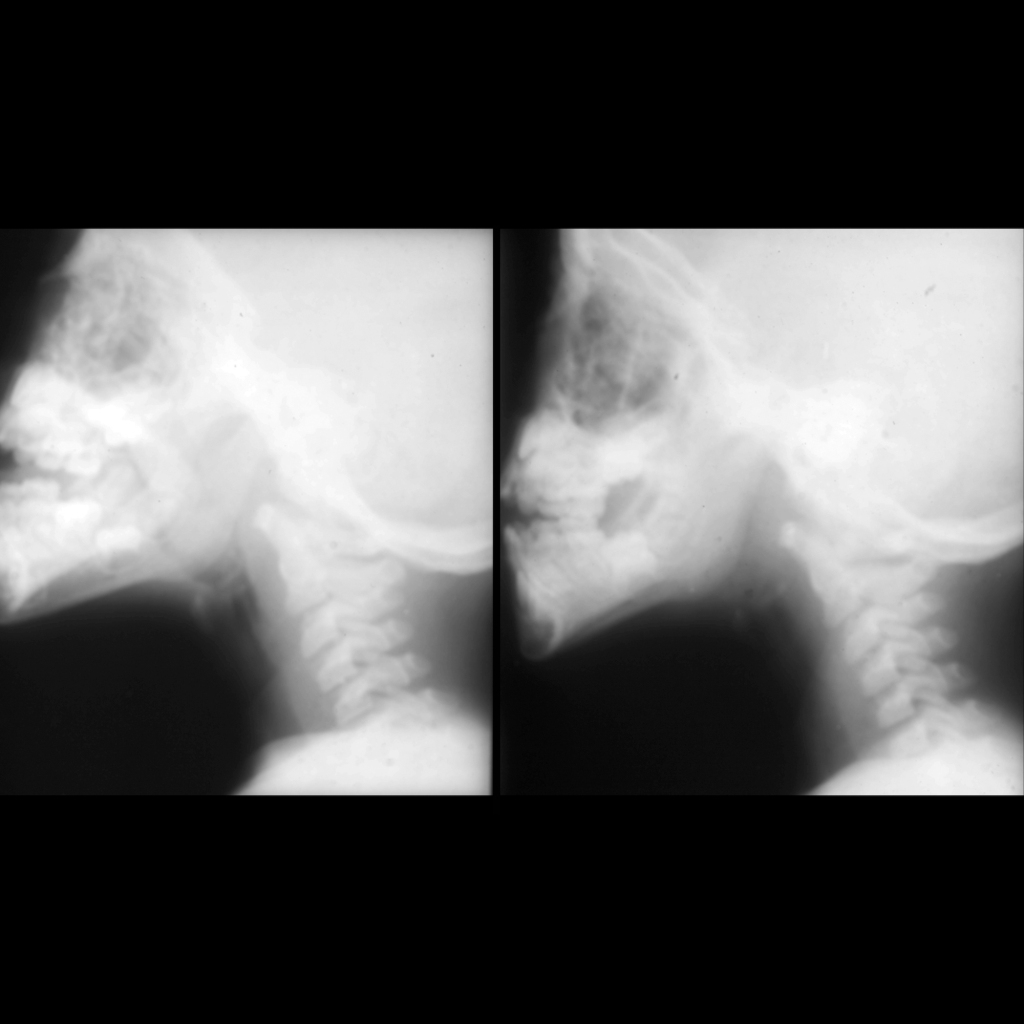 Radiograph of adenoid tonsil hypertrophy and palatine tonsil hypertrophy