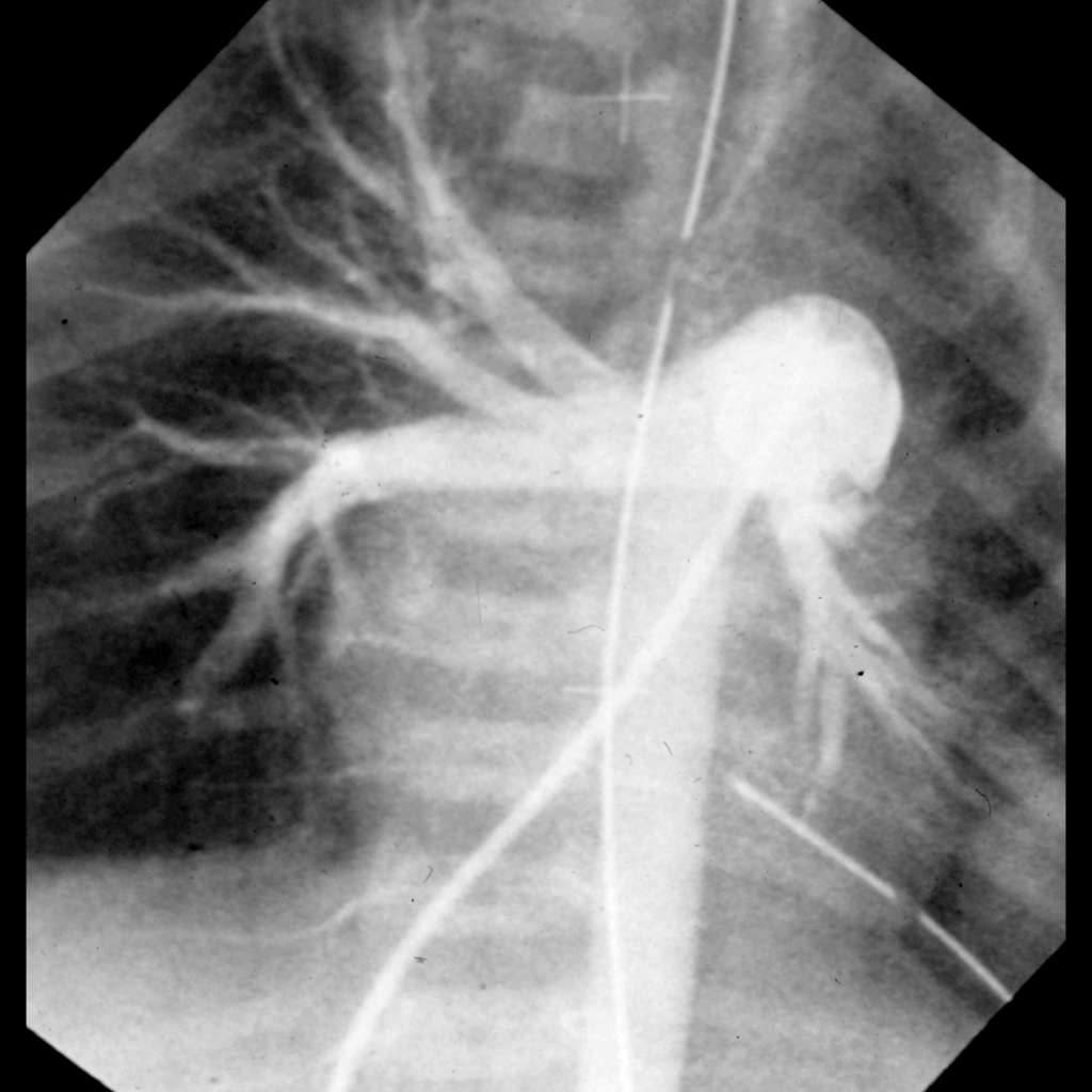 Angiogram of patent ductus arteriosus
