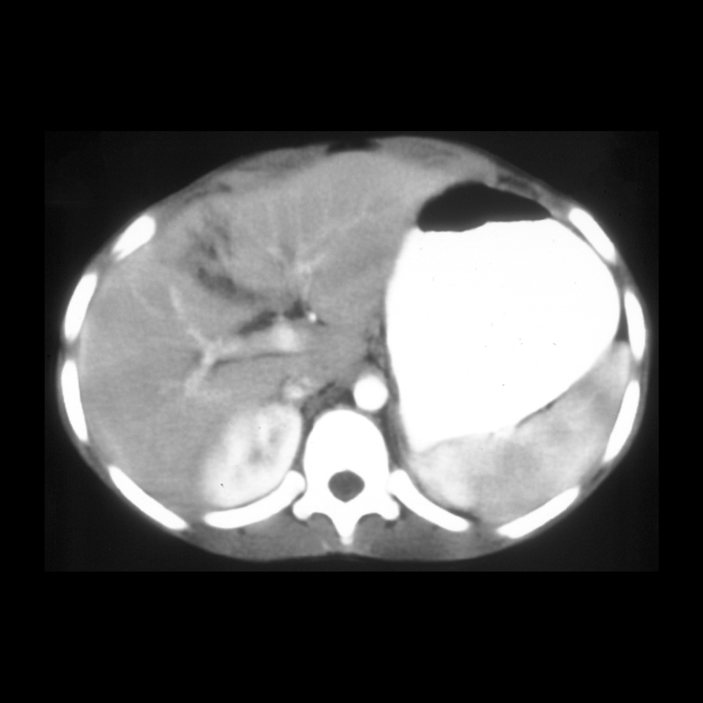 CT of inhomogenous enhancement of the spleen and liver laceration
