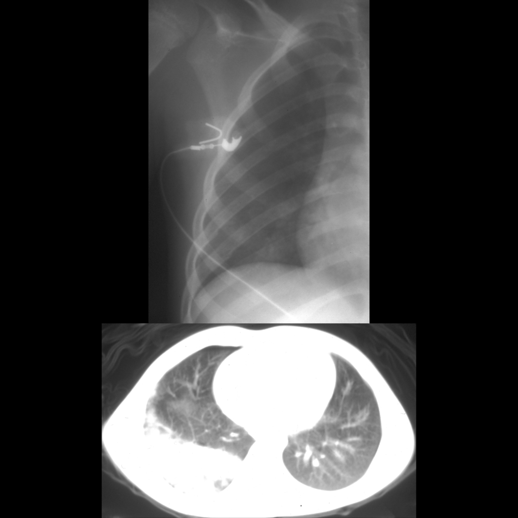 CXR and CT of rib fracture and pulmonary contusion