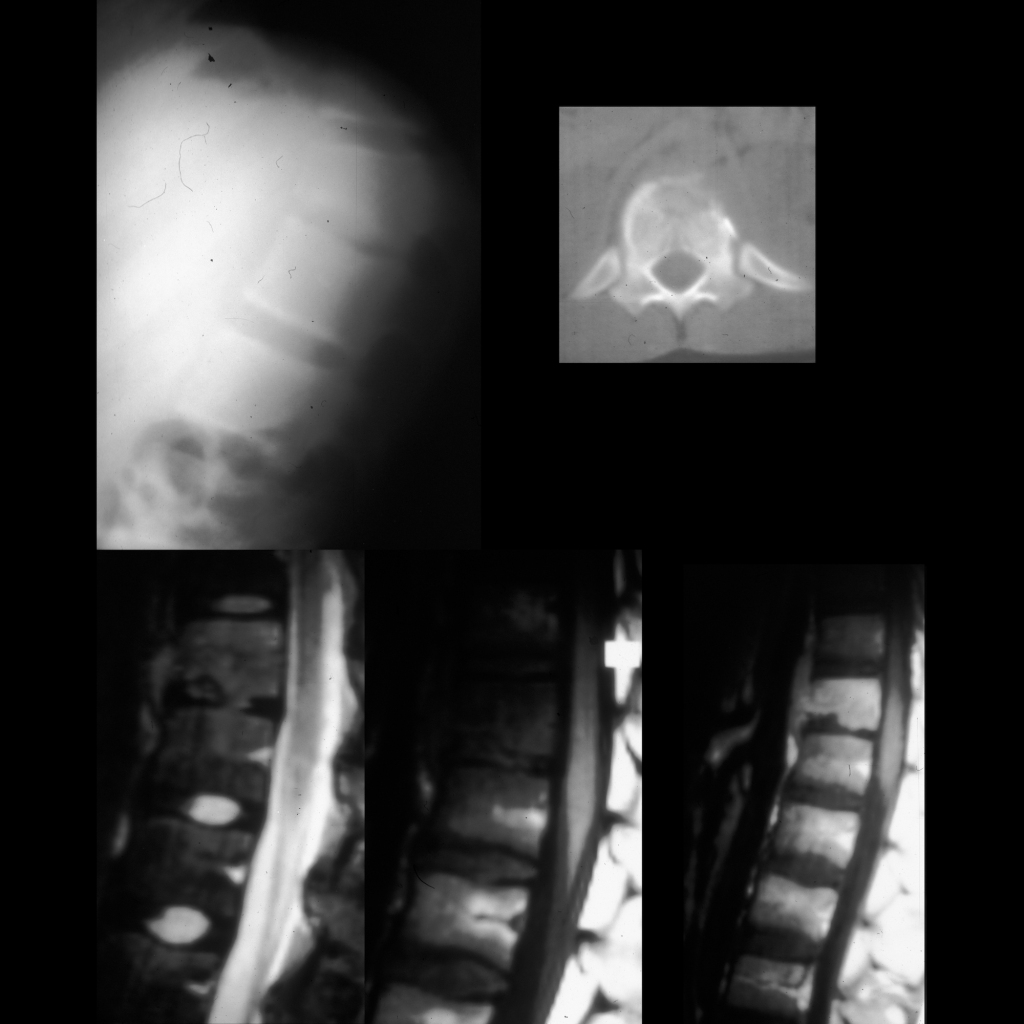 Radiograph and CT scan and MRI scan of diskitis / osteomyelitis of the spine