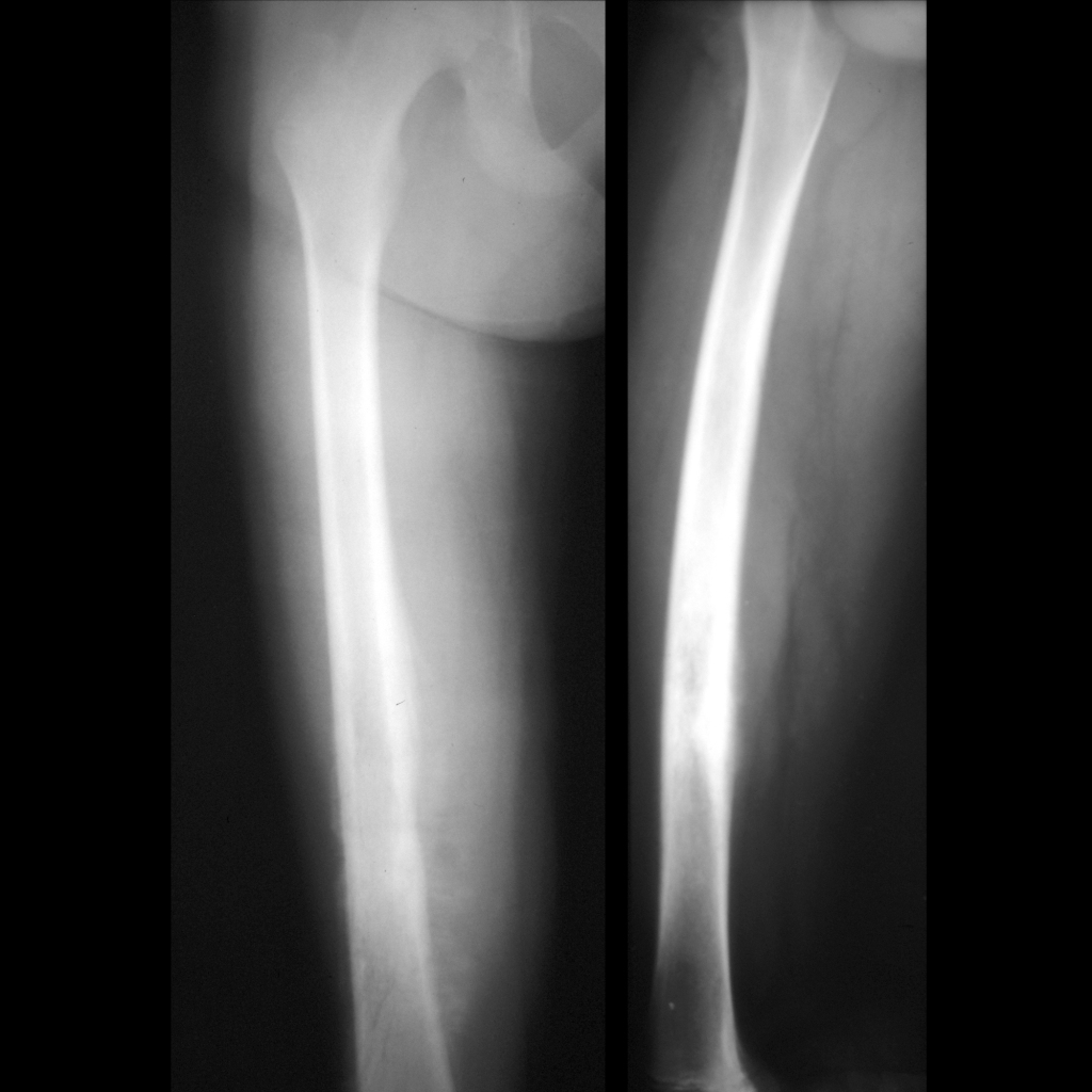 Radiograph of osteosarcoma of the femur