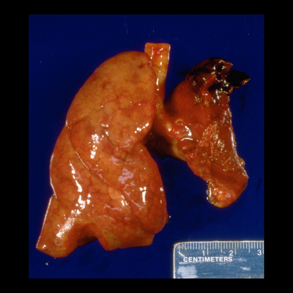 Pathologic image of congenital diaphragmatic hernia
