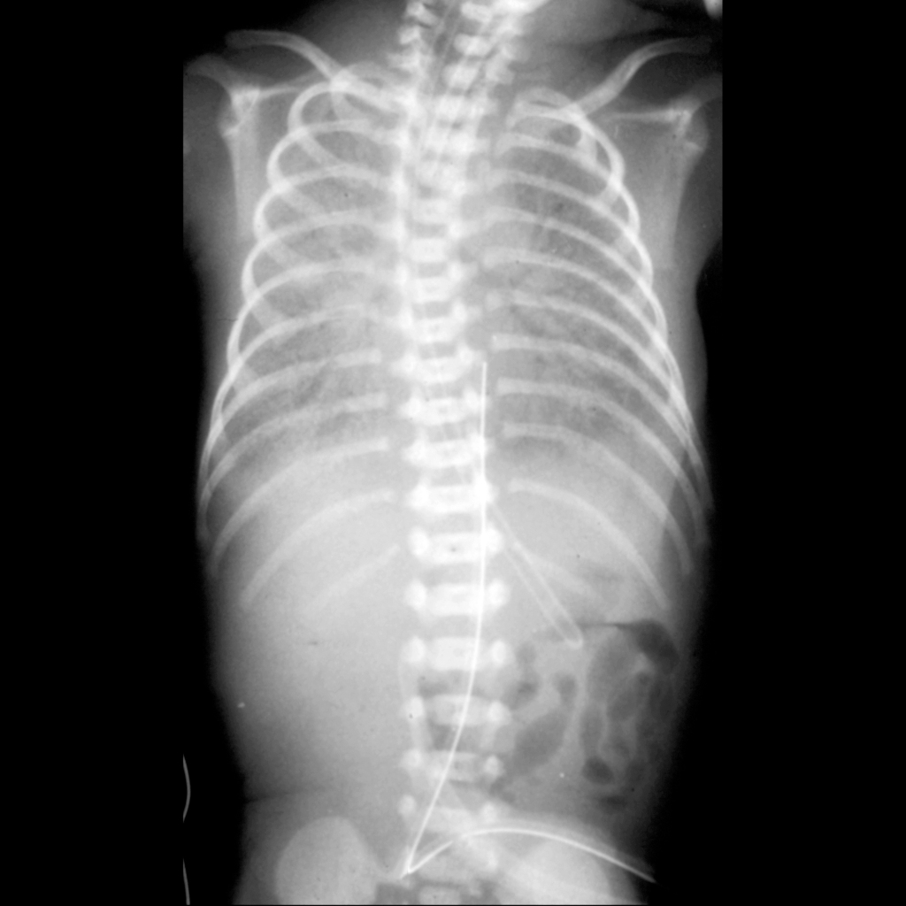 CXR of correctly positioned endotracheal tube in a patient with respiratory distress syndrome