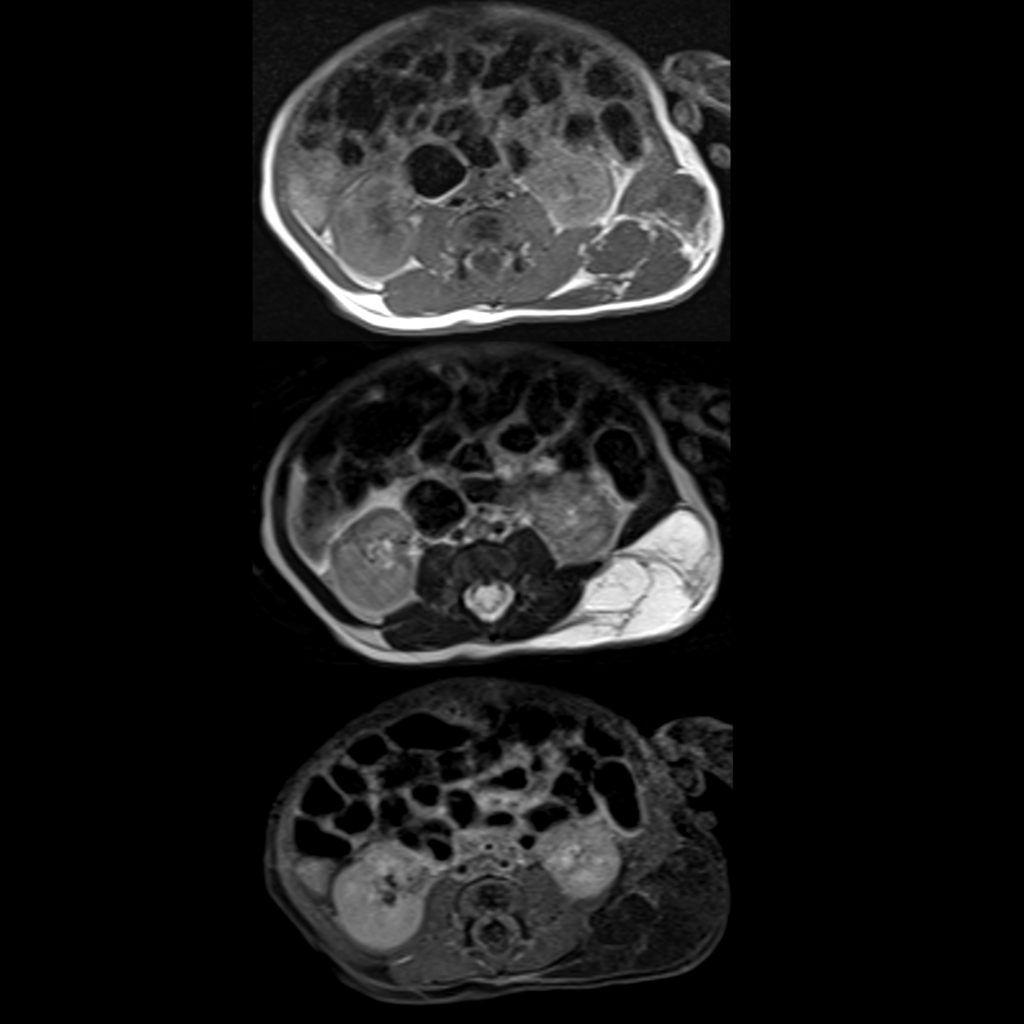 MRI of lymphatic malformation of the chest wall