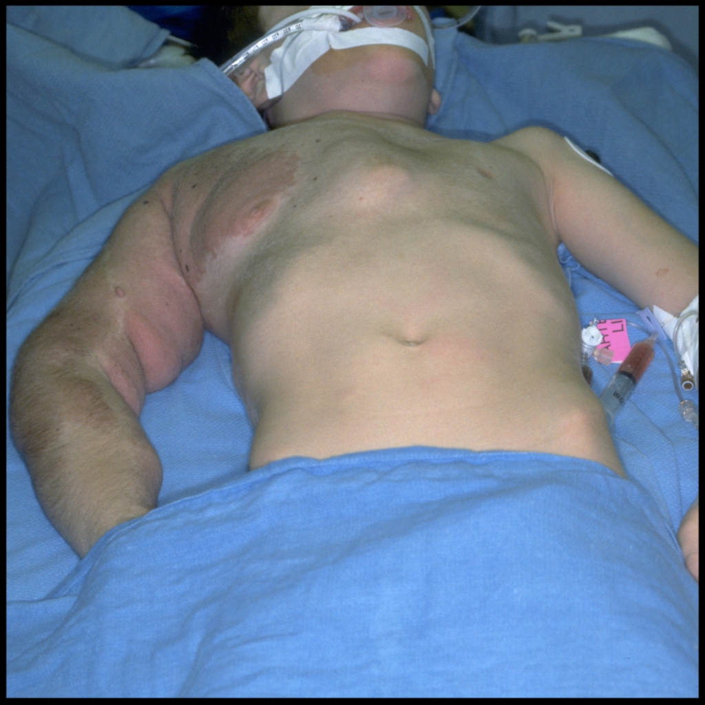 Clinical image of neurofibromatosis type 1 with chest wall and arm plexiform neurofibromas