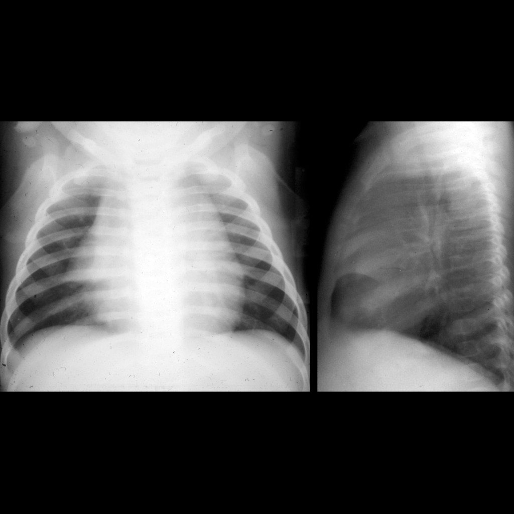 CXR of normal thymus with sail sign