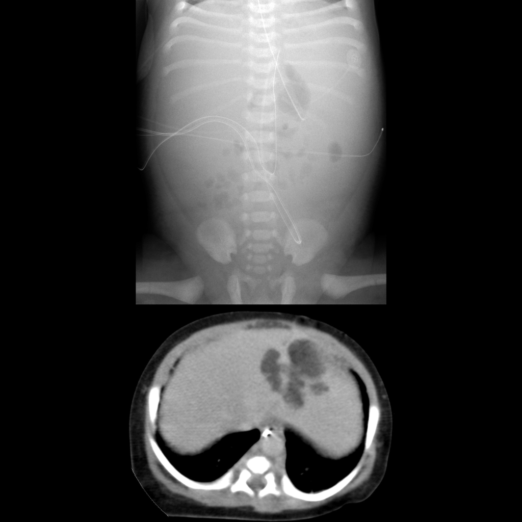 AXR and CT of extravasation of TPN into the liver due to umbilical venous catheter perforation out of the vein