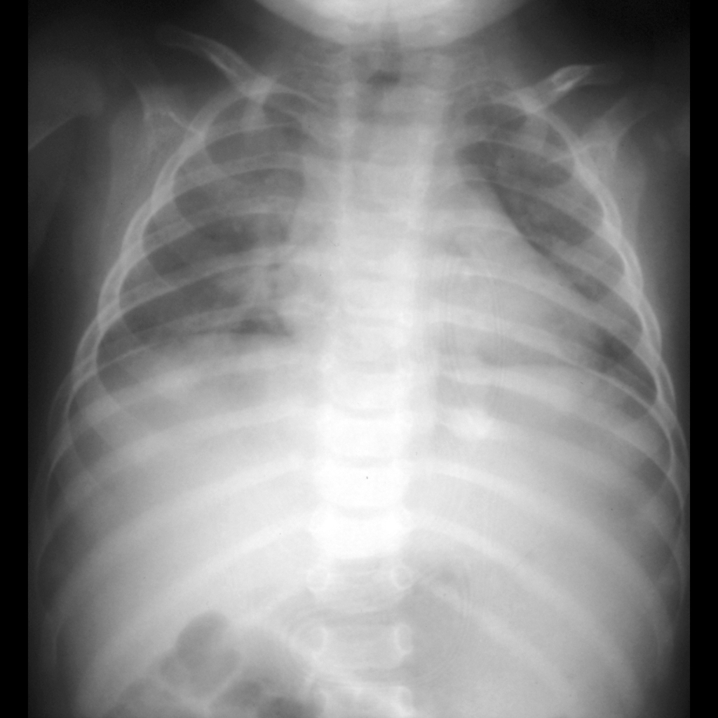 CXR of posterior rib fractures in child abuse