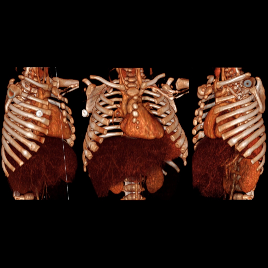 3D CT construction of anterior rib fractures in child abuse