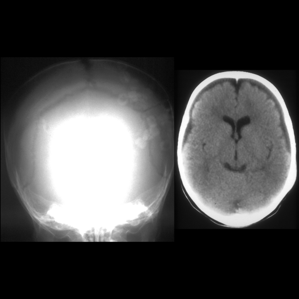 Radiograph of parietal skull fracture and CT of chronic subdural hematomas in child abuse