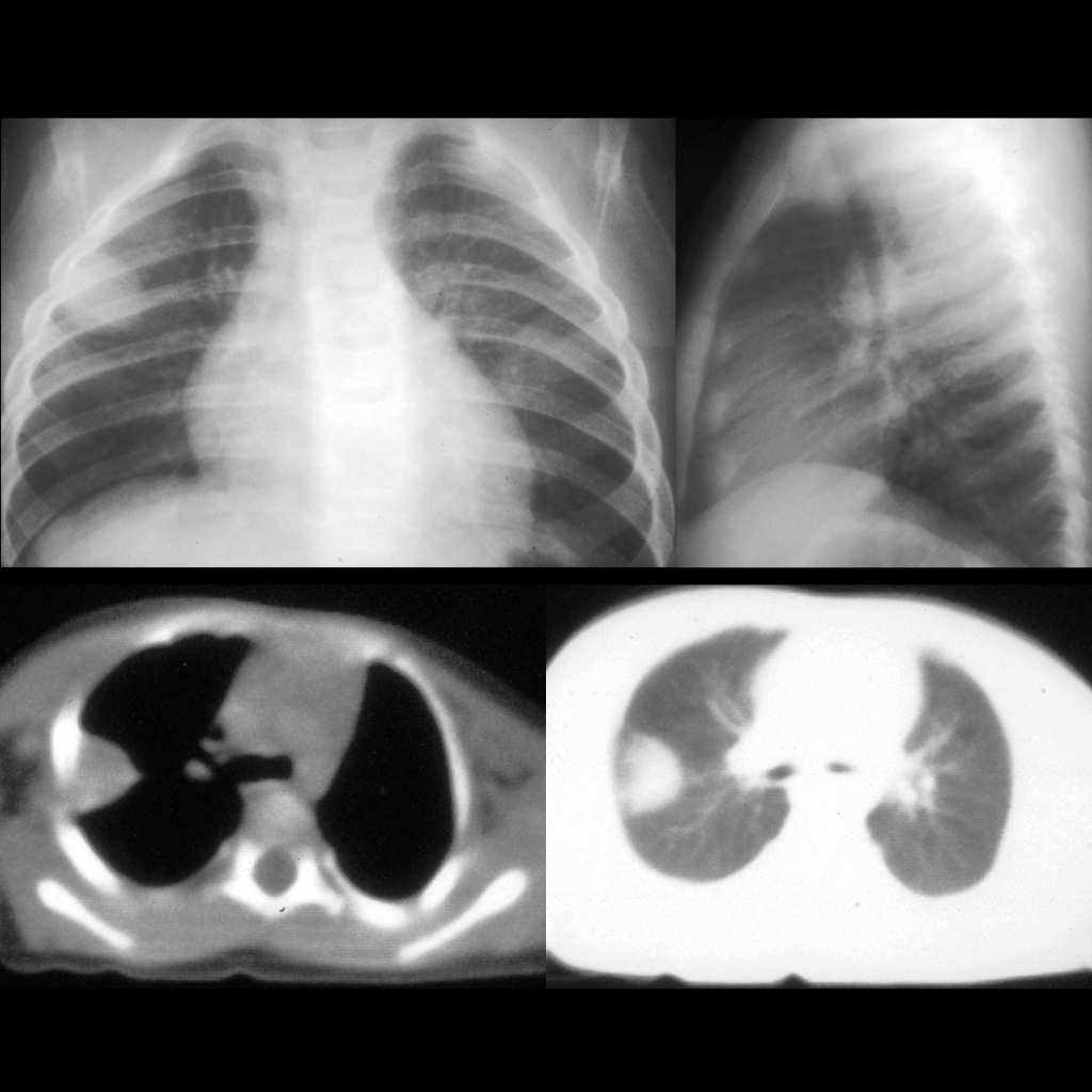 CXR and CT of inflammatory myofibroblastic tumor in the chest