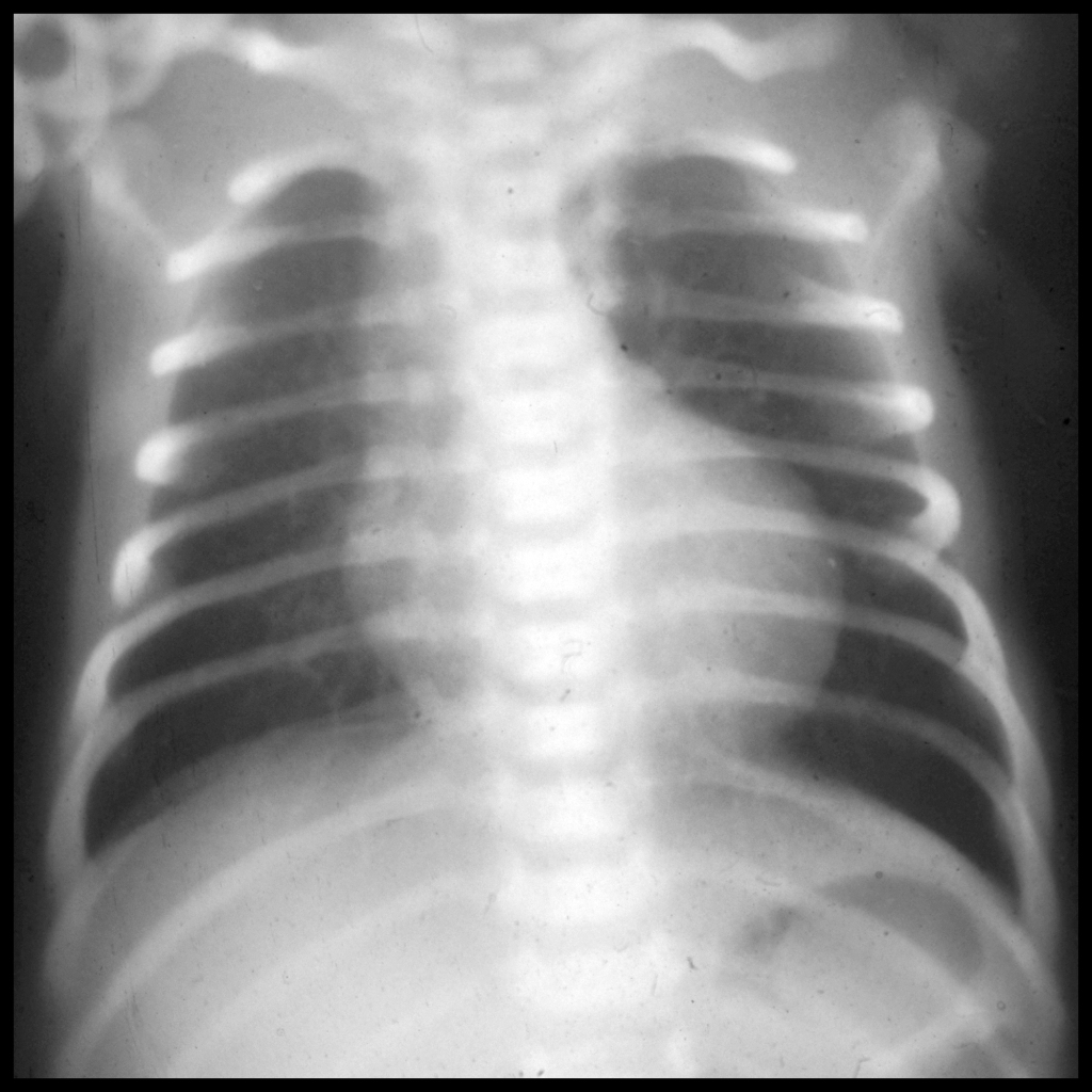 CXR of pulmonary atresia with intact ventricular septum
