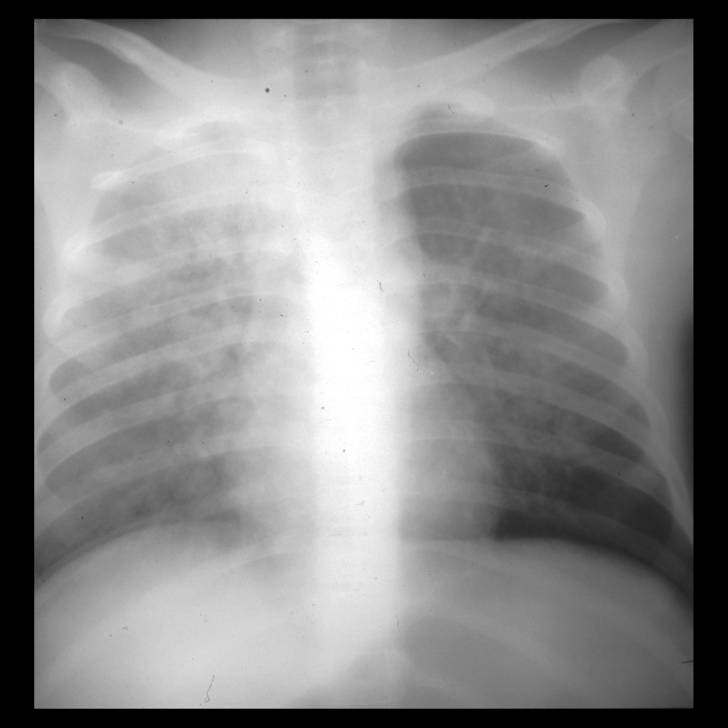 CXR of pulmonary edema in near drowning