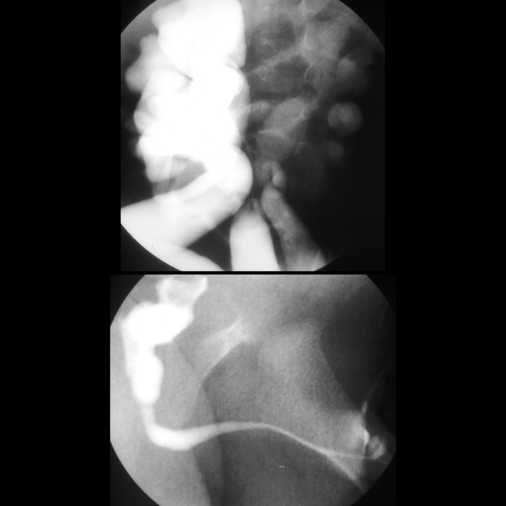 VCUG of posterior urethral valves