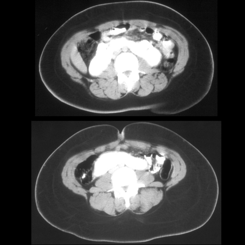 CT of horseshoe kidney