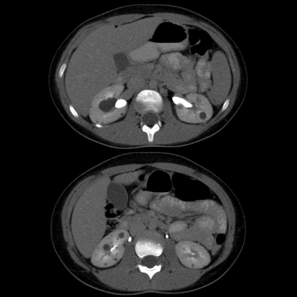 CT of autosomal dominant polycystic kidney disease