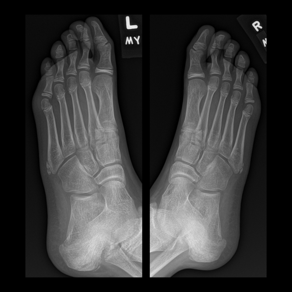 Radiograph of apophyseal fracture of the fifth metatarsal