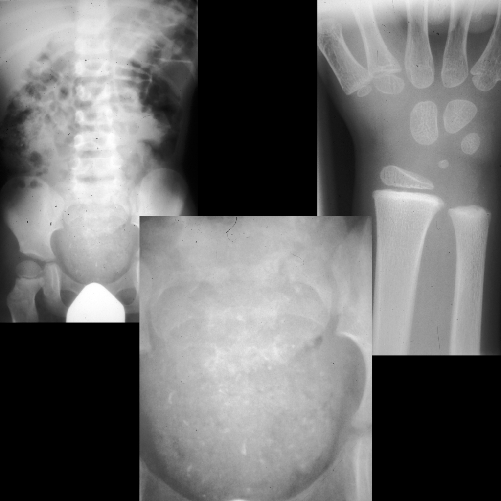 Radiograph of lead poisoning