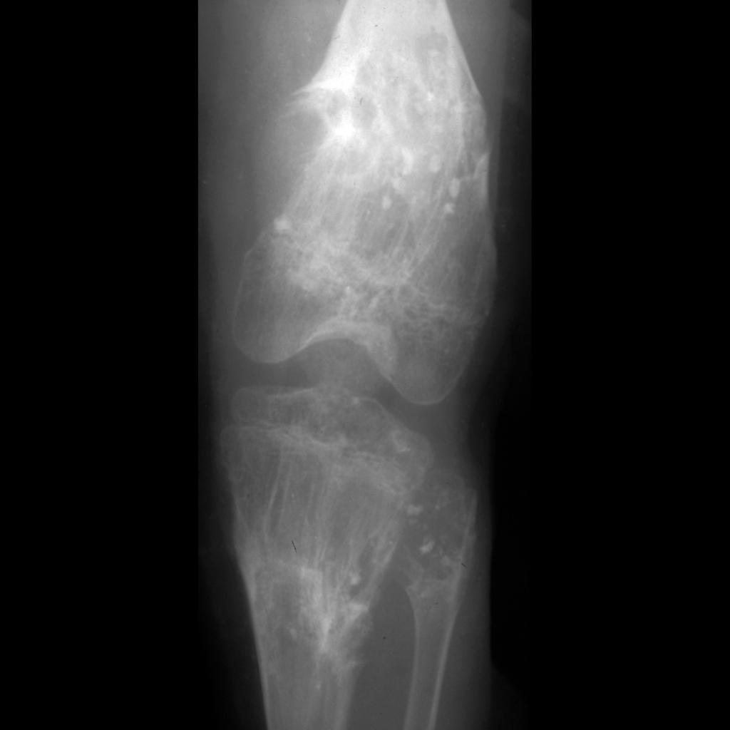 Radiograph of multiple enchondromas of knee in Ollier disease