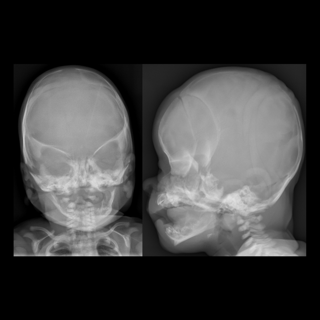 Radiograph of bilateral coronal craniosynostosis