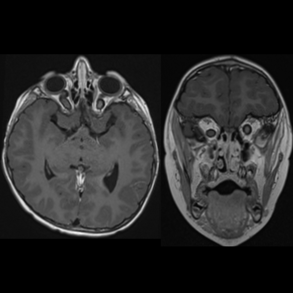 MRI of optic pathway gliomas in neurofibromatosis type I
