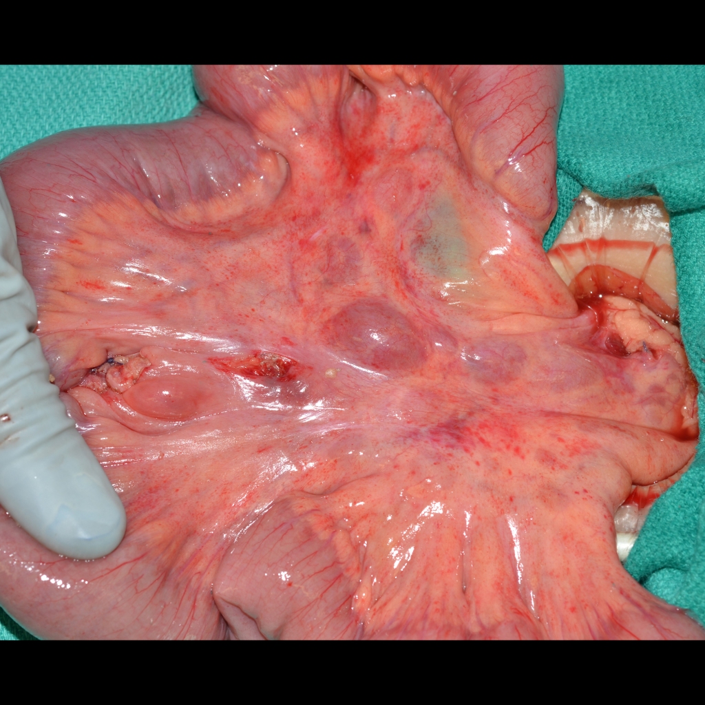 Surgical image of Non-Hodgkin lymphoma in the mesentery