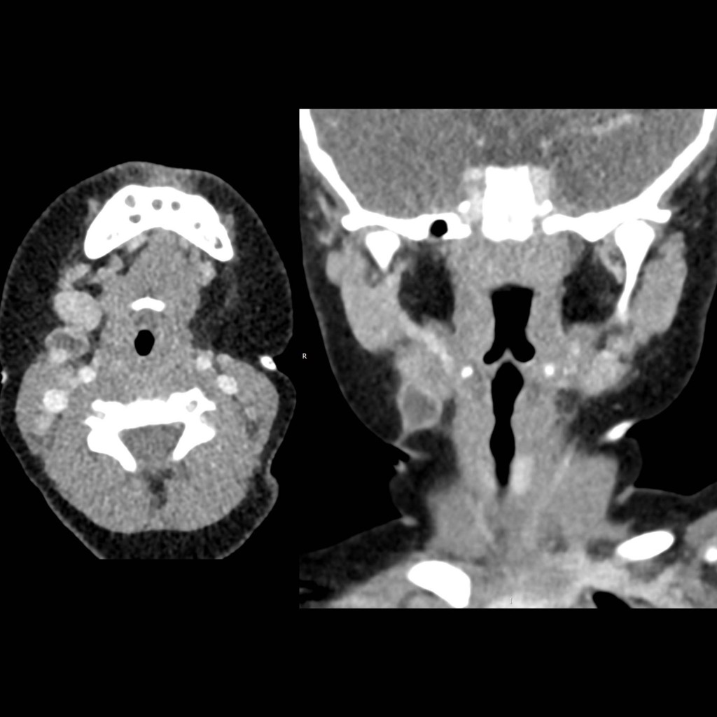 CT of second branchial cleft cyst