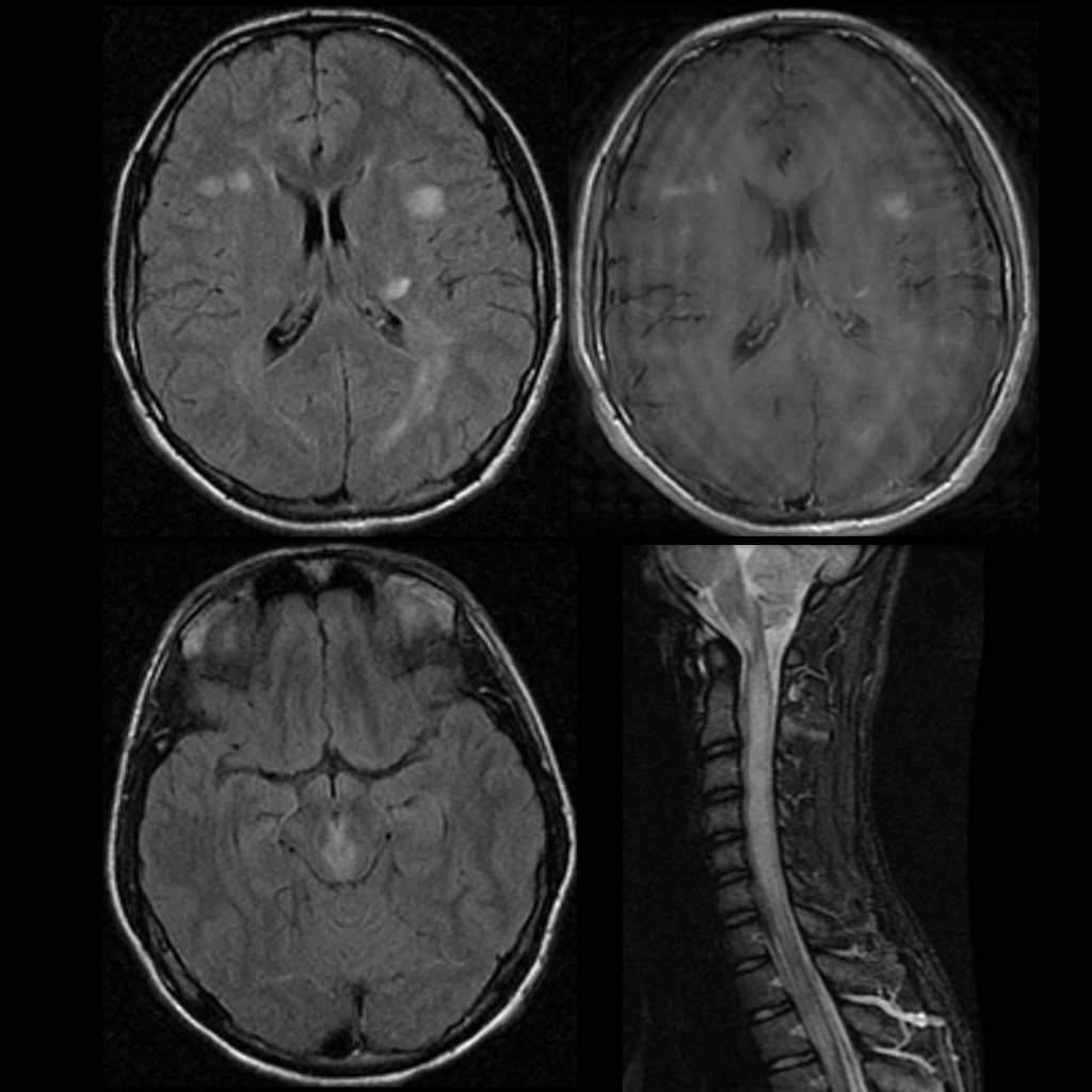 MRI of acute disseminated encephalomyelitis / ADEM
