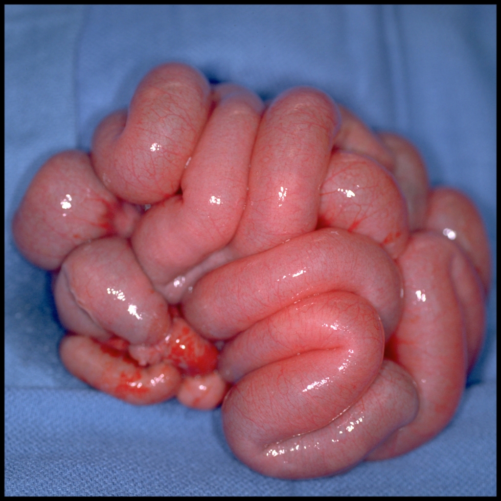 Infant with non-bilious and bilious vomiting and a distended abdomen