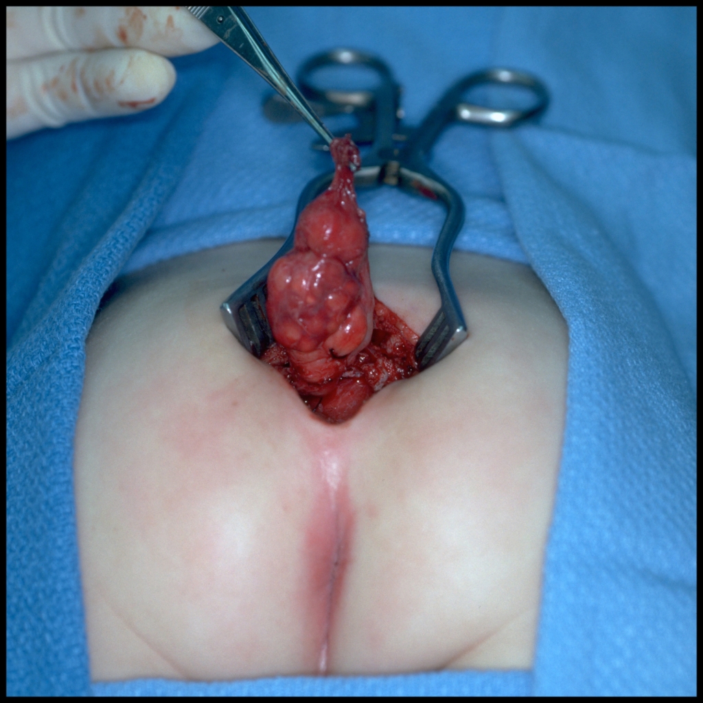 Surgical image of presacral neuroblastoma