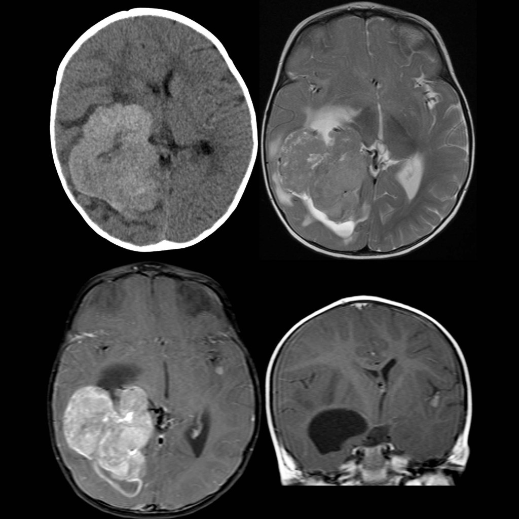 CT and MRI of choroid plexus carcinoma