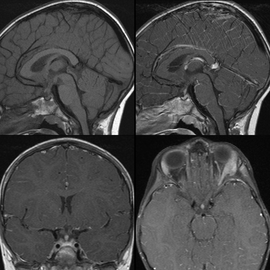 MRI of Langerhans cell histiocytosis of the pituitary