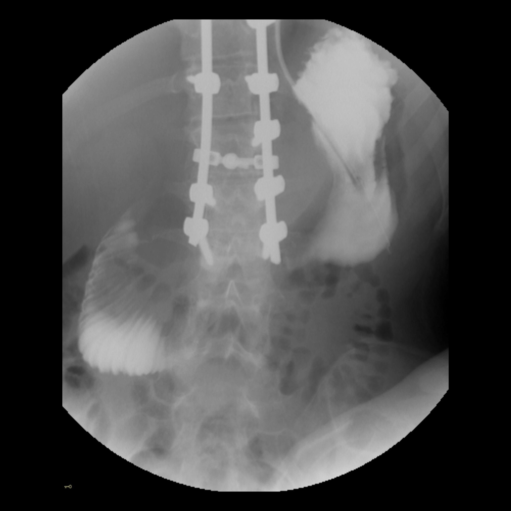 Teenager with vomiting after posterior spinal fusion 1 week ago