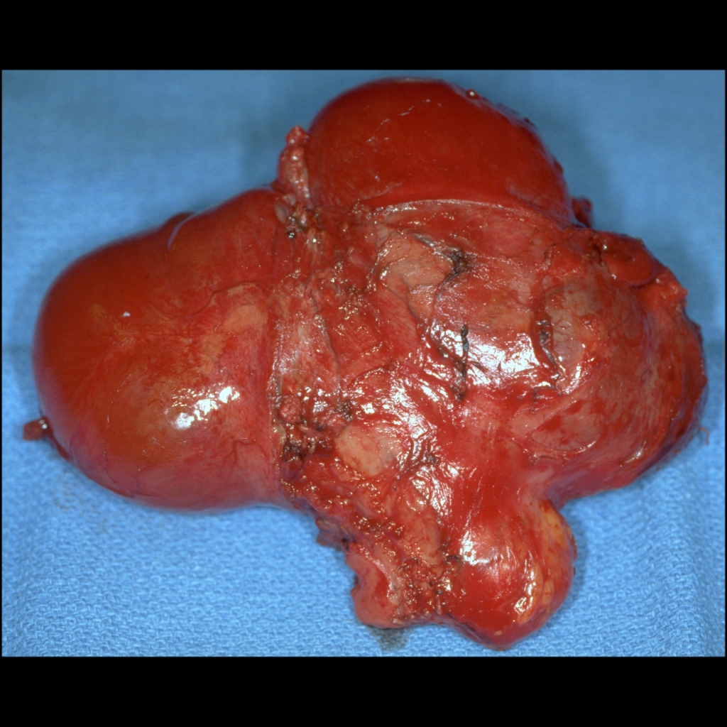 Gross pathology image of embryonal rhabdomyosarcoma of the bladder