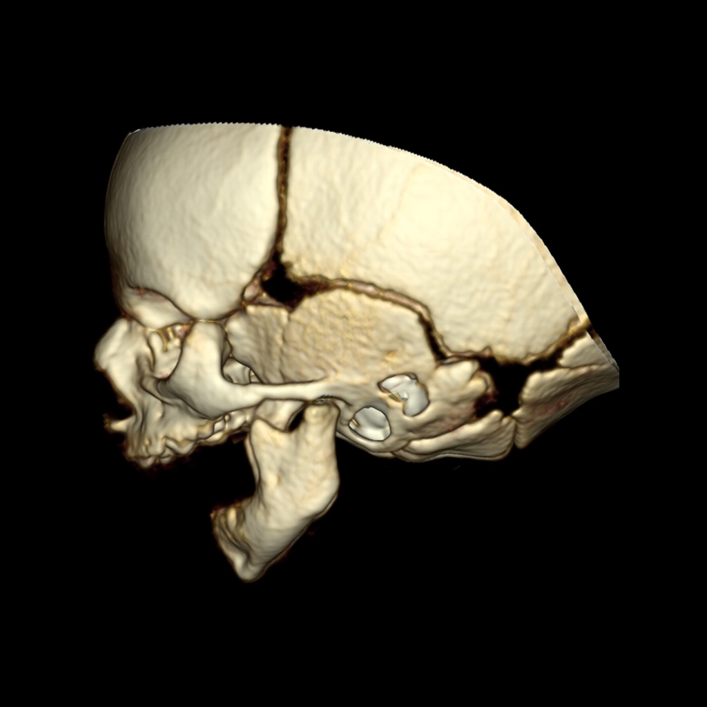 3D CT of Pierre Robin syndrome
