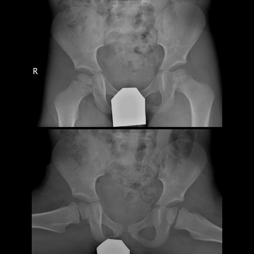 Radiograph of transient synovitis of the hip