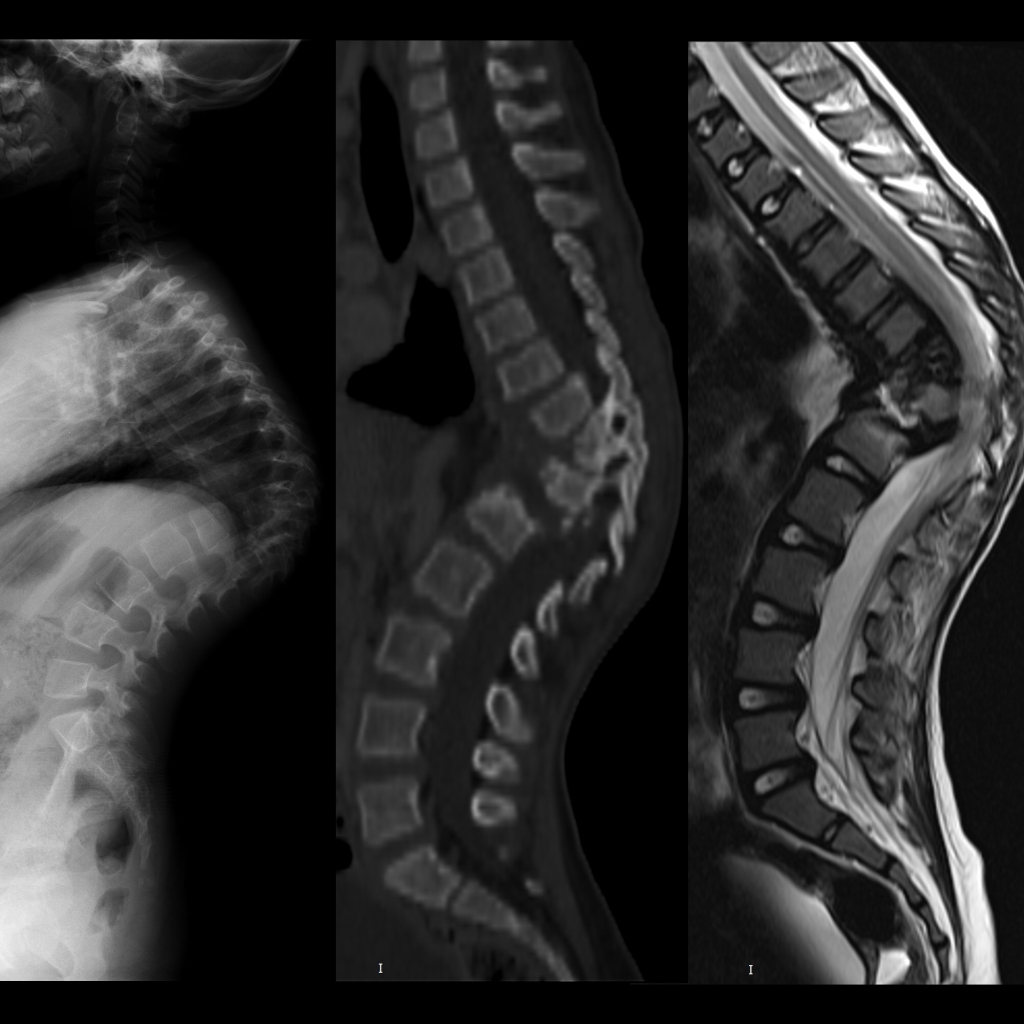 Radiograph and CT and MRI of tuberculous osteomyelitis of the spine