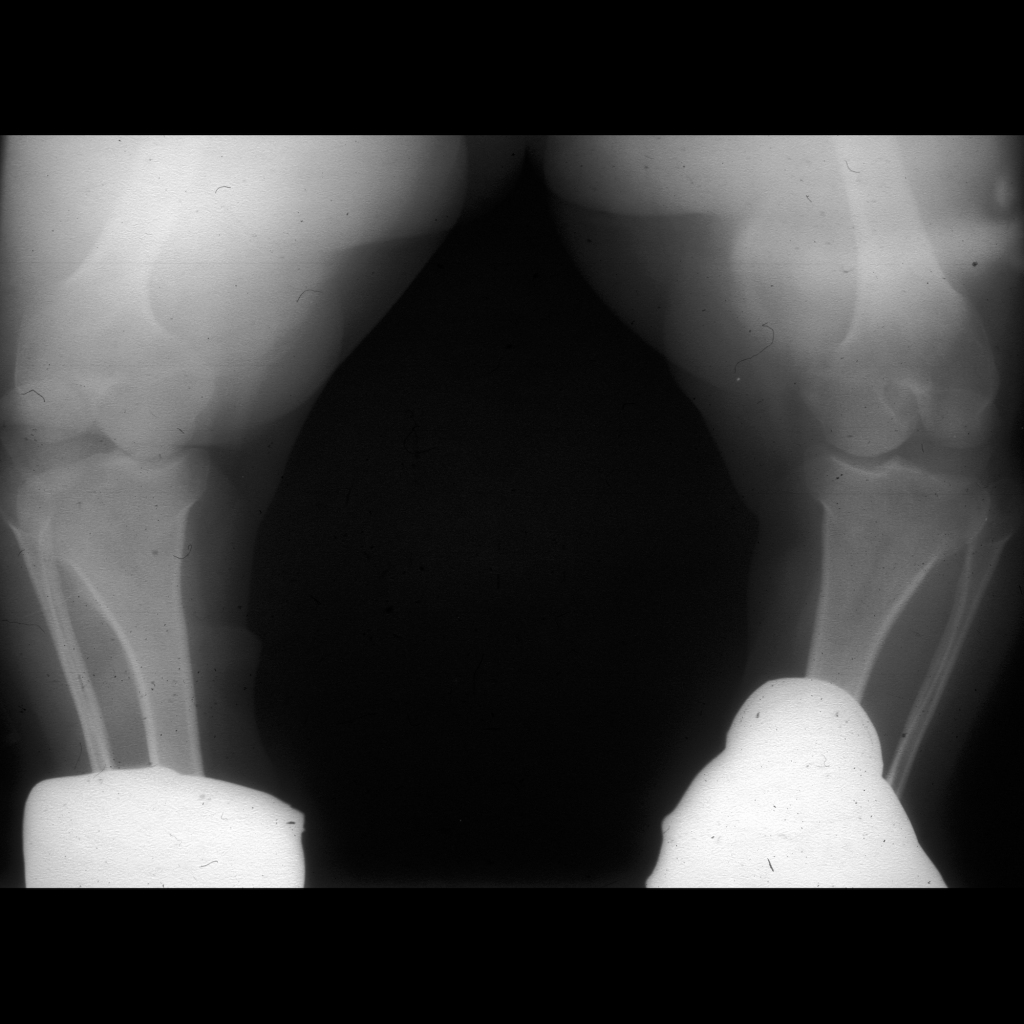 Radiograph of achondroplasia with shortened femurs