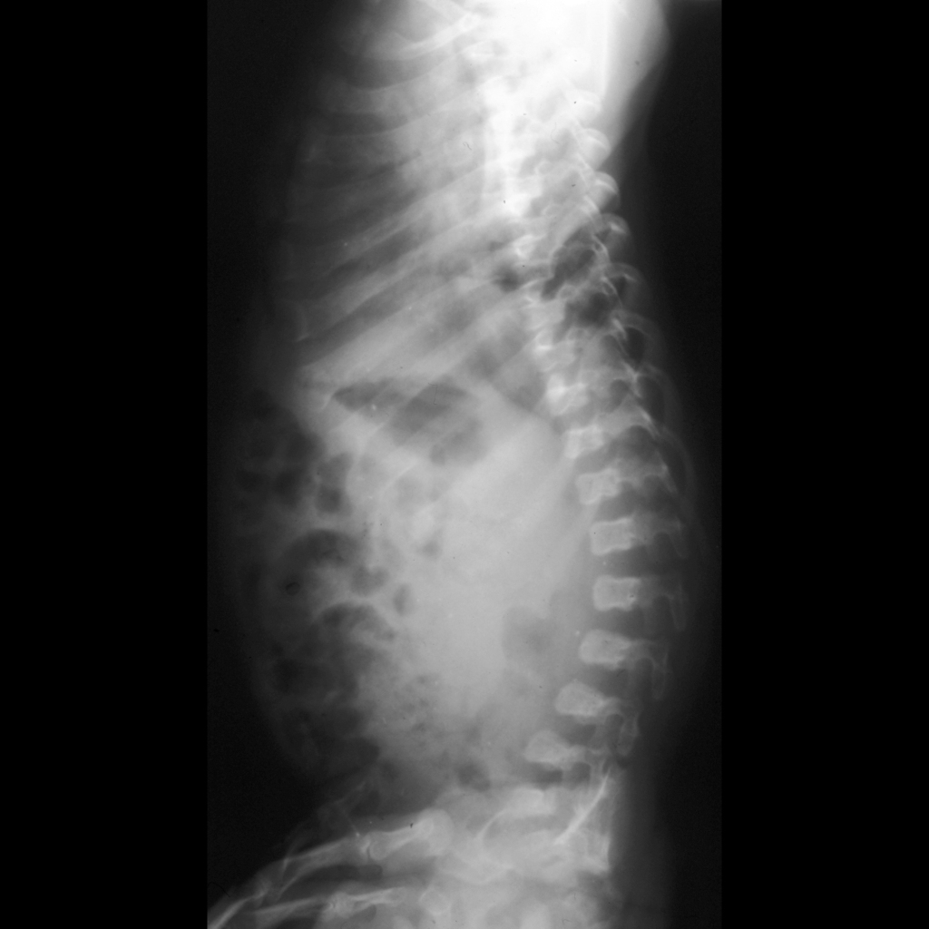 Spine radiograph of achondroplasia
