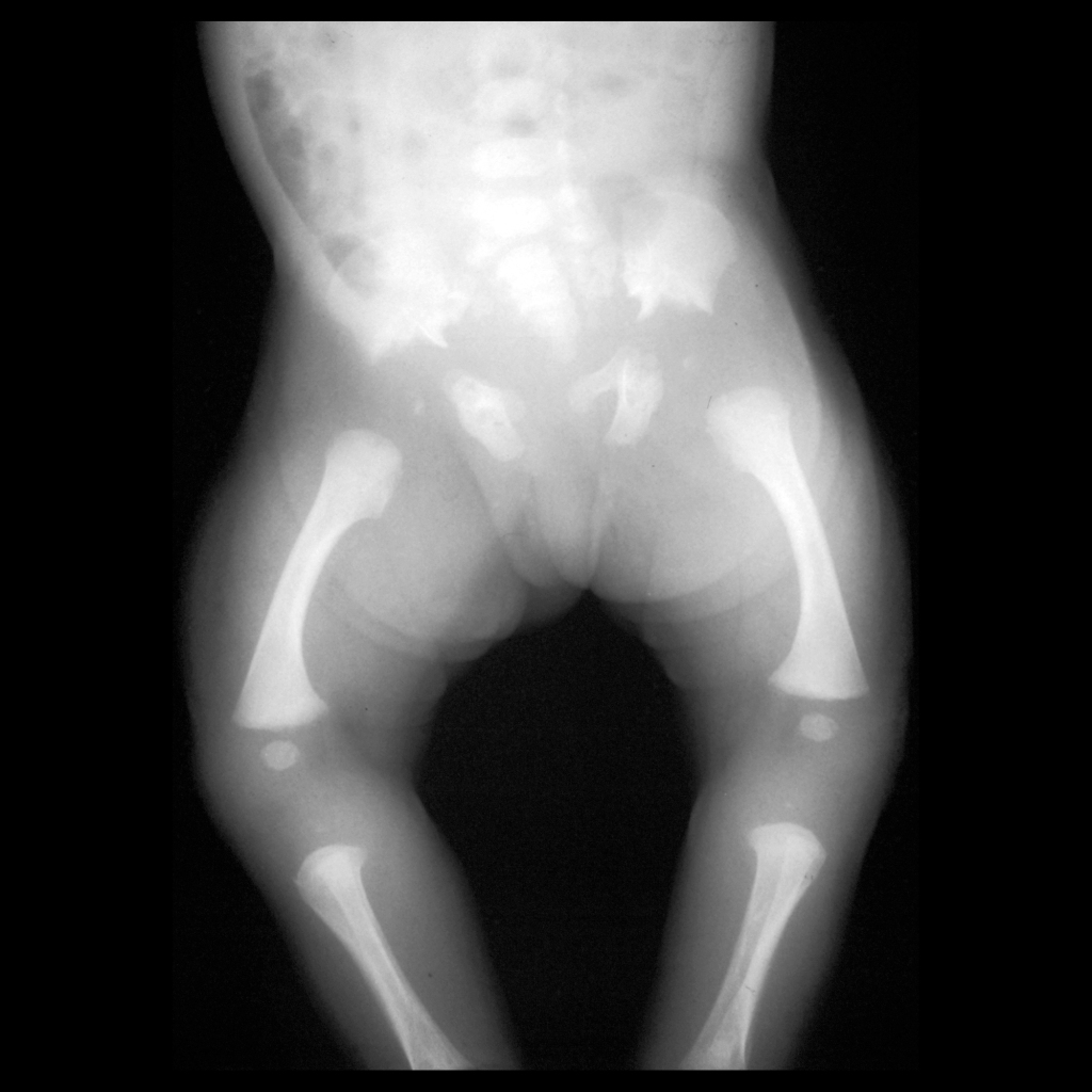 Radiograph of trident pelvis of asphyxiating thoracic dystrophy