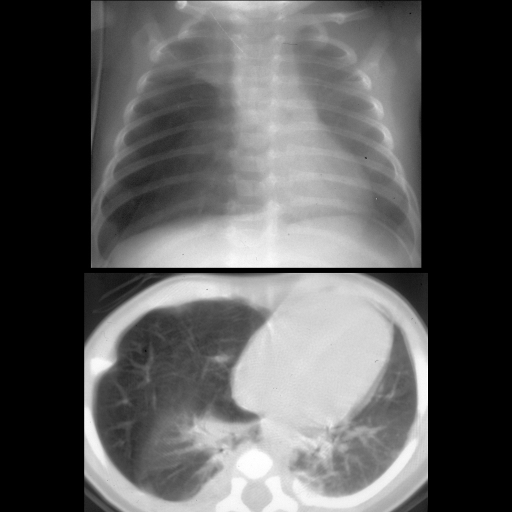 CXR and CT of congenital lobar emphysema