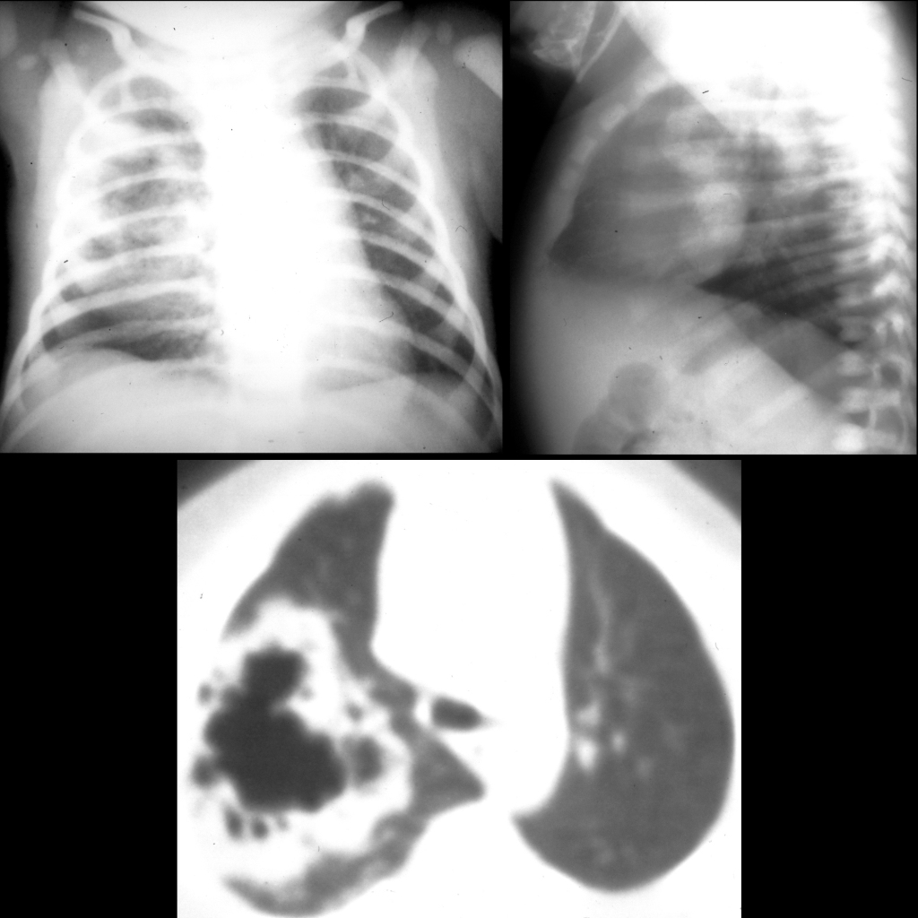 CXR and CT of congenital pulmonary airway malformation type I