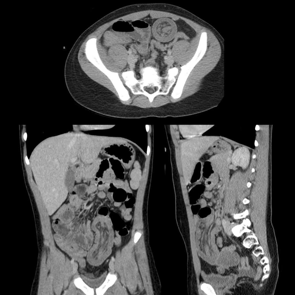 CT of small bowel-small bowel intussusception due to Burkitt lymphoma