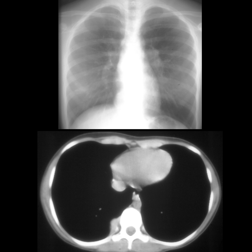 CXR and CT of lung metastasis in Wilms tumor