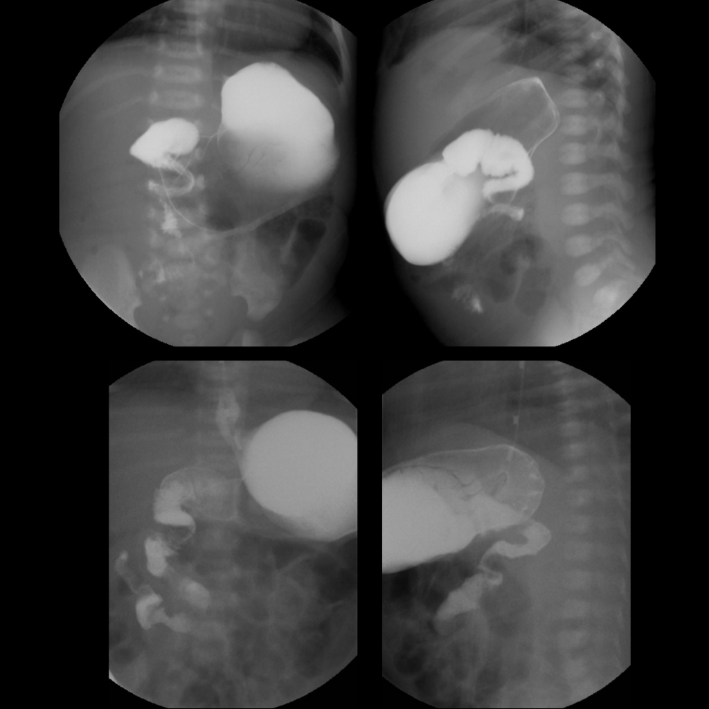UGI of malrotation with midgut volvulus before and after a Ladd procedure