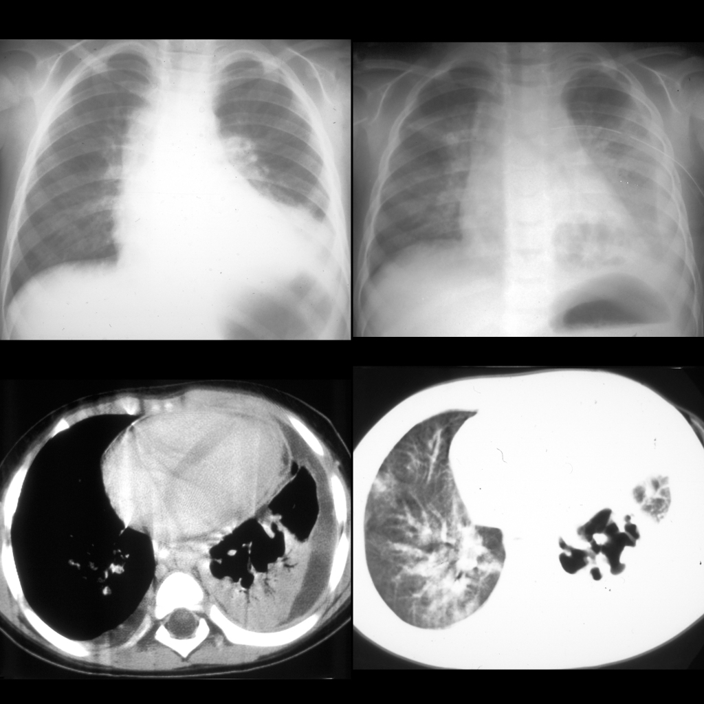 CXR and CT of post-infectious pneumatocele