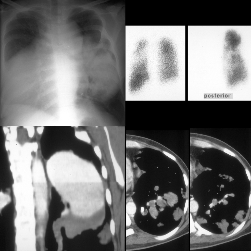 CXR and V/Q scan and CT of pulmonary embolism