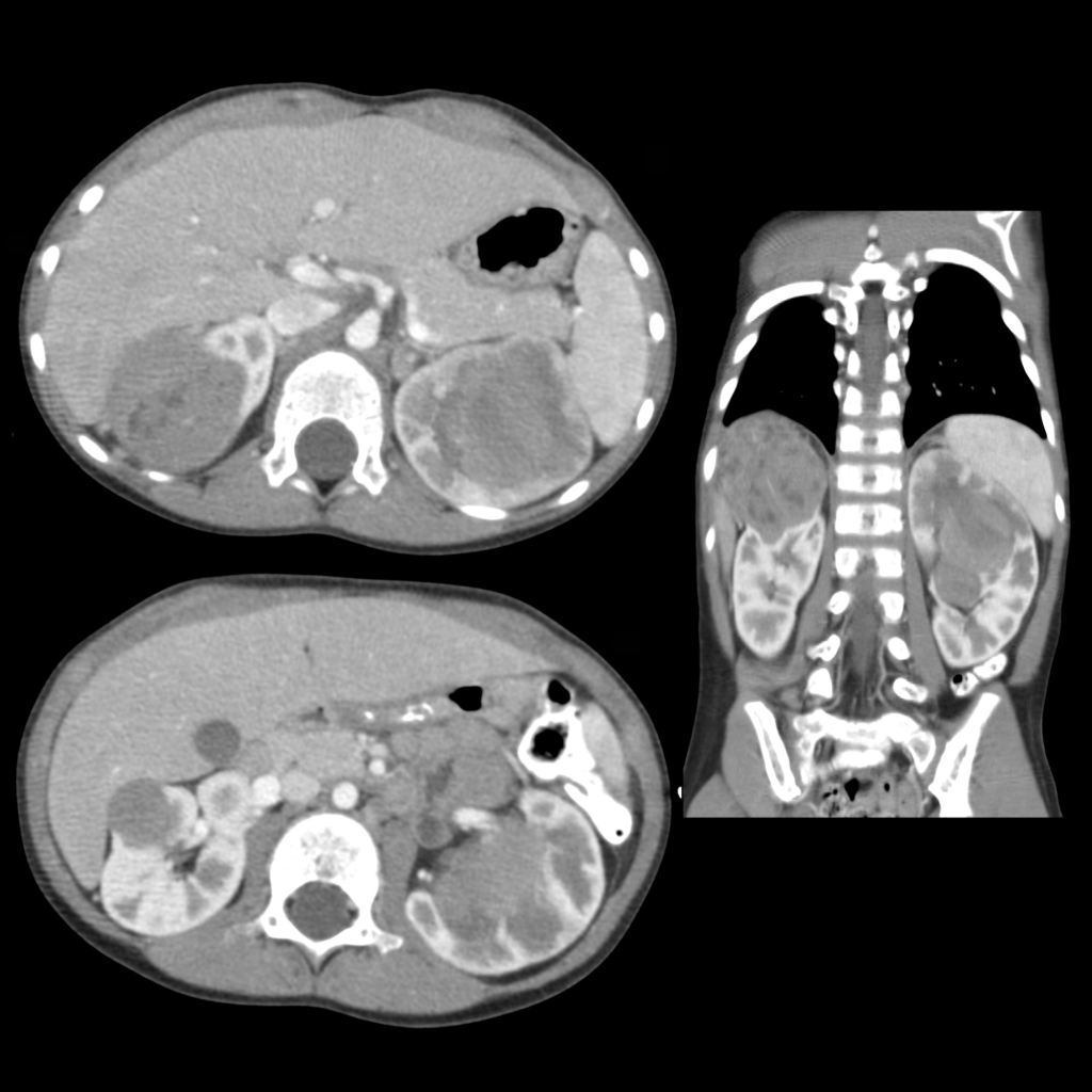 CT of bilateral Wilms tumor